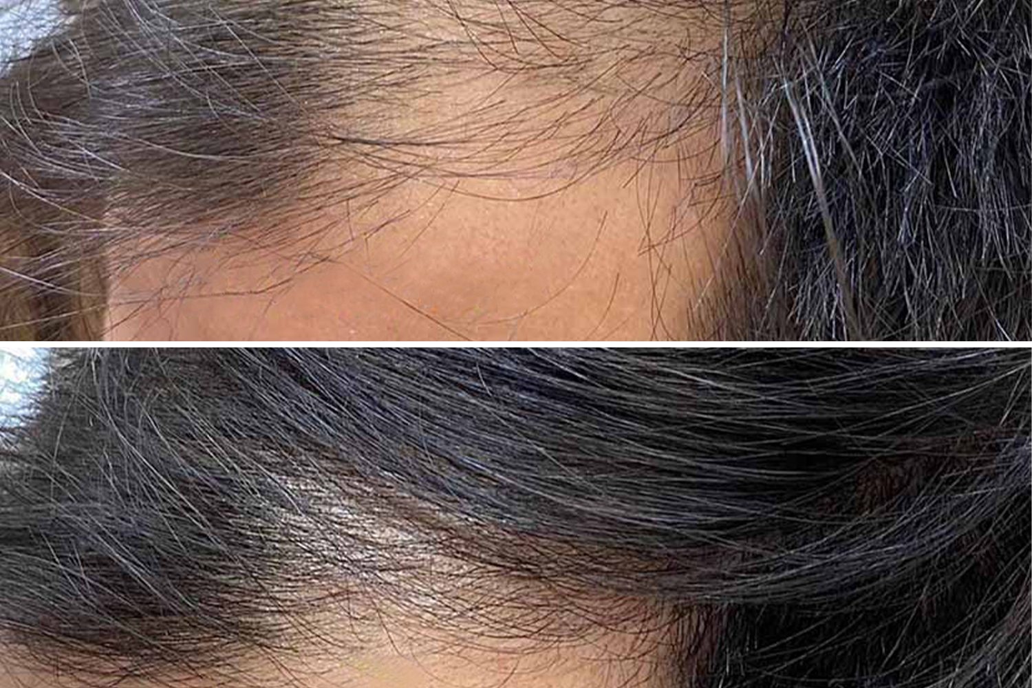 Tratamiento PhiLings realizado por la Maestra Asociada Saba Barati Tratamiento PhiLings realizado por la Maestra Asociada Saba Barati