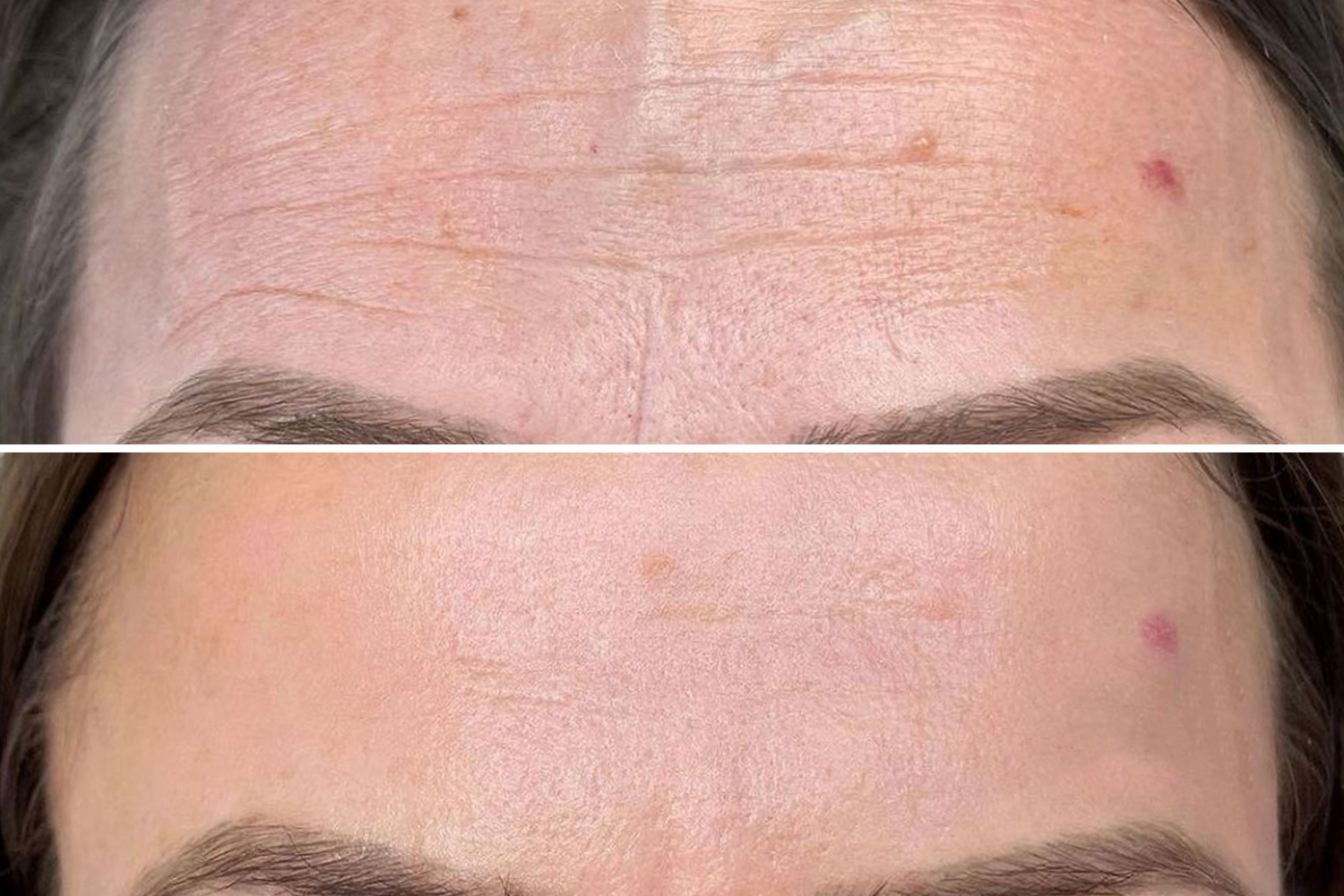 Técnico de PhiIon - Svitlana Bidzilia realizando un tratamiento con microneedling. Técnico de PhiIon - Svitlana Bidzilia realizando un tratamiento con microneedling.