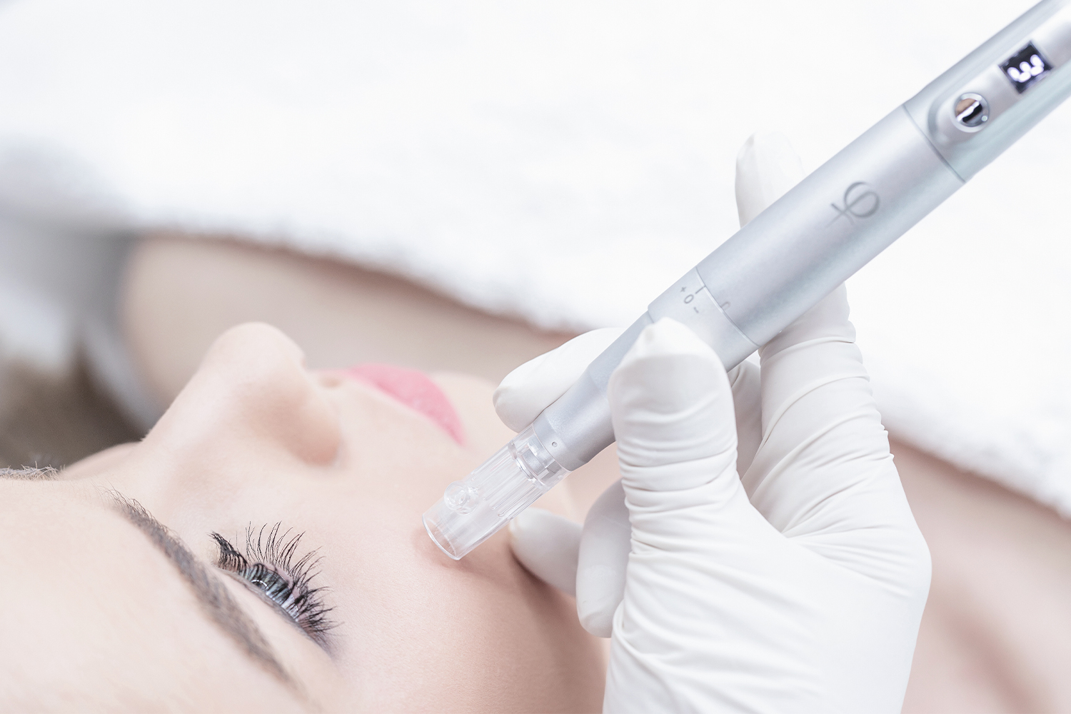 Procedimiento de microneedling con dermapen Procedimiento de microneedling con dermapen